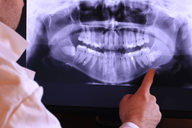 Best Emergency Wisdom Teeth Removal in Mount Carmel, TN